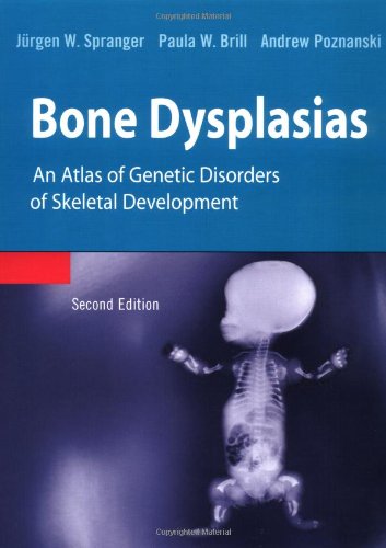Bone Dysplasias