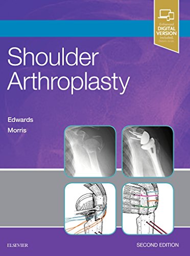 Book Cover Shoulder Arthroplasty