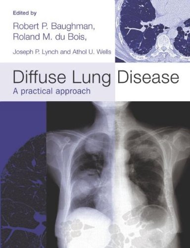Diffuse Lung Disease: A practical approach (Hodder Arnold Publication)