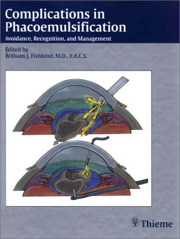 Complications in Phacoemulsification: Avoidance, Recognition, and Management