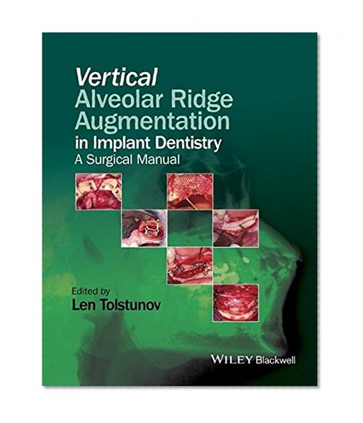 Vertical Alveolar Ridge Augmentation in Implant Dentistry: A Surgical Manual