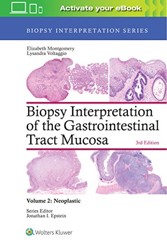 Book Cover Biopsy Interpretation of the Gastrointestinal Tract Mucosa: Volume 2: Neoplastic (Biopsy Interpretation Series)