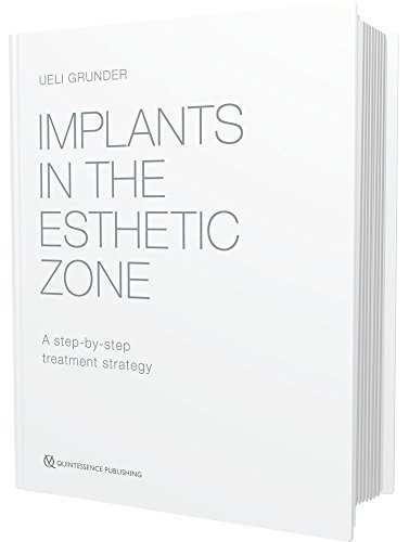 Book Cover Implants in the Esthetic Zone: A Step-by-Step Treatment Strategy