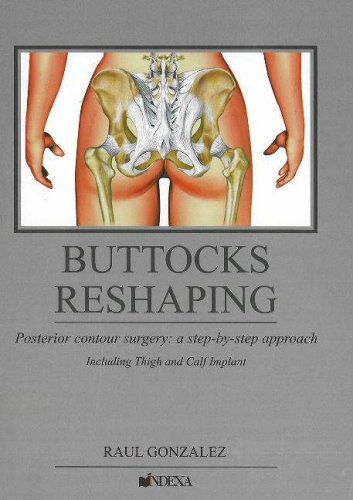 Buttocks Reshaping: Posterior Contour Surgery: A Step-by-step Approach Including Thigh and Calf Implant