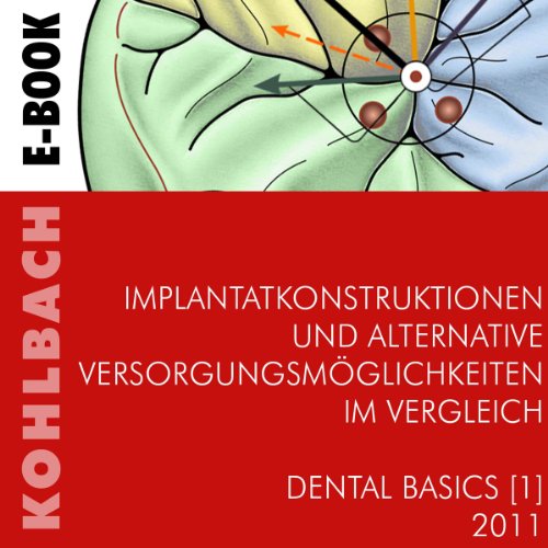 Implantatkonstruktionen und alternative VersorgungsmÃ¶glichkeiten im Vergleich (Dental Basics 1) (German Edition)