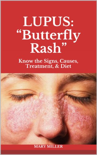 LUPUS: "Butterfly Rash": Know the Signs, Causes, Treatment, & Diet