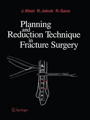 Planning and Reduction Technique in Fracture Surgery by Jeffrey Mast (2011-10-01)