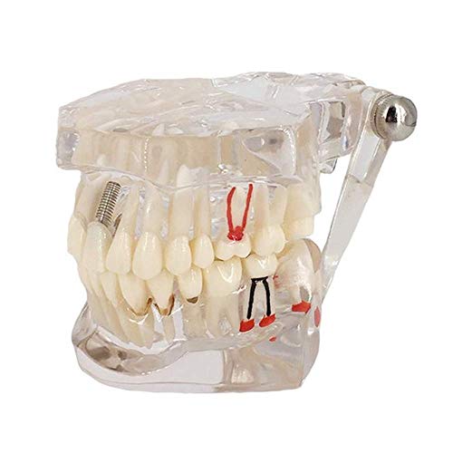 Transparent Disease Teeth Model, YOUYA DENTAL Transparent Dental Implant Teeth Model Dentist Standard Disease Removable Tooth Pathological Teaching Model