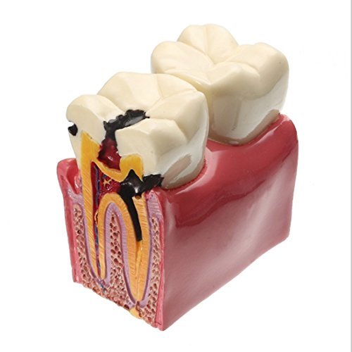 Dental Caries Tooth Model, YOUYA DENTAL Decay Teeth Comparative Study Model 6 Times Caries Tooth Teaching Tools