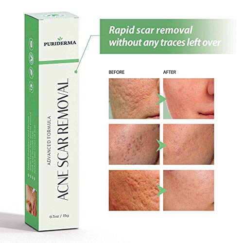 Acne Scar Removal Cream Treatment for Face, Remove & Lighten Old & New Scars, Spots & Marks, Natural, Gentle & Effective Herbal Extracts Formula - by PuriDerma (0.5oz/15g)